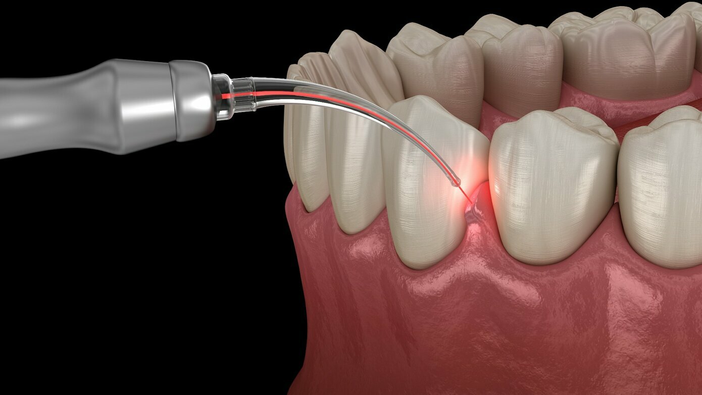 Soft tissue Laser Application, Technique, Precautions, and Contradictions