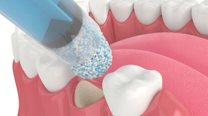 Periodontal Regeneration: Saving the Natural Dentition