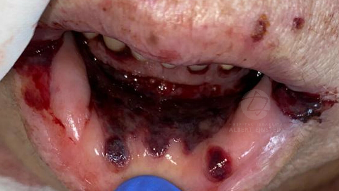 COVID-19 and oral cavity