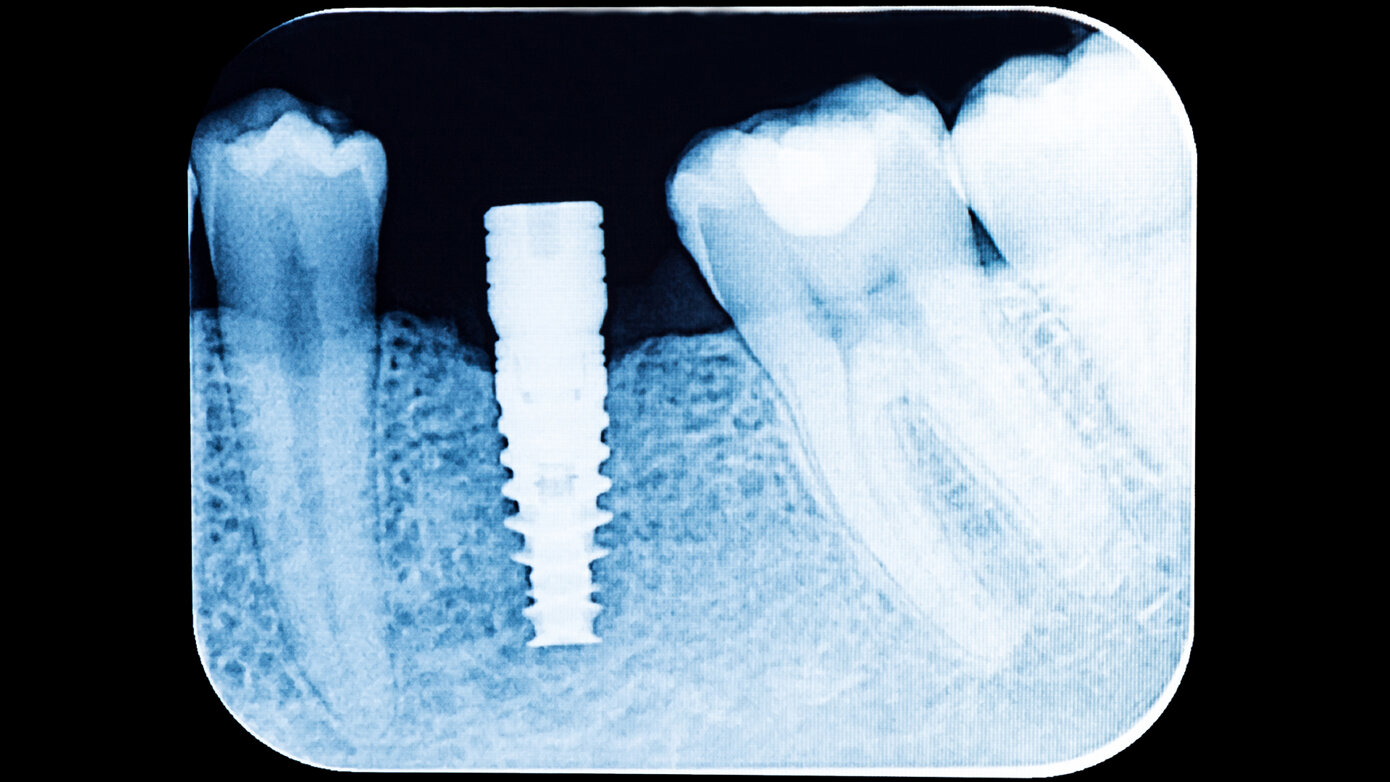 Periodontitis and Implant Complications: Update on the Linkage