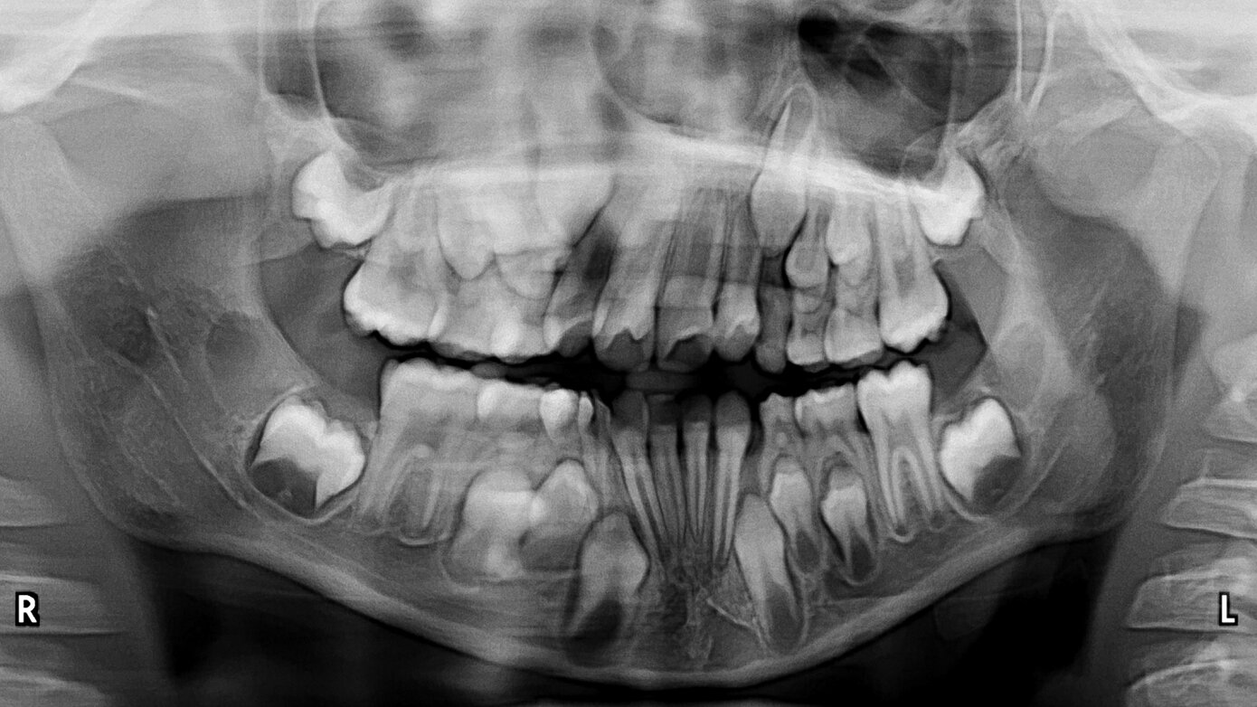 Variants of normal radiologic anatomy that may simulate disease on panoramic images Part 2