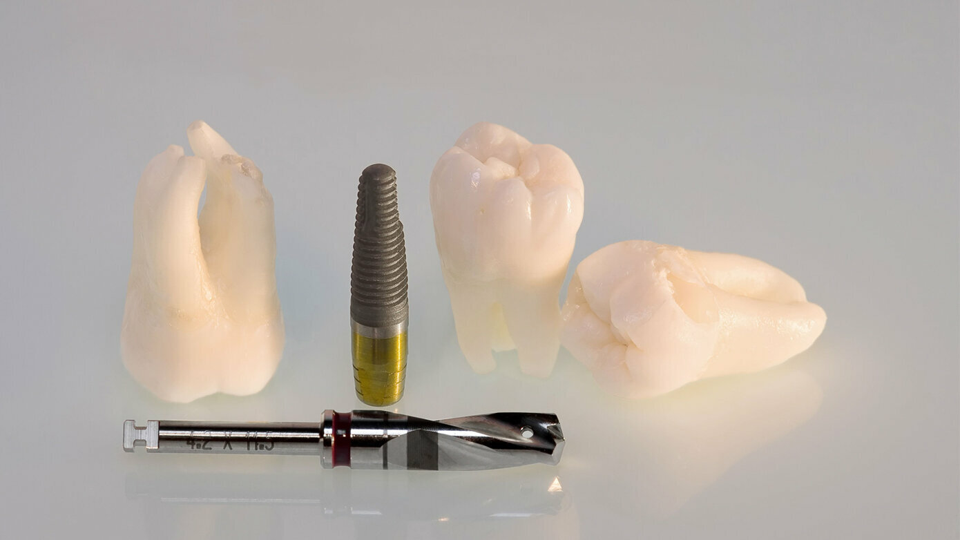 Tooth Retention vs. Tooth Extraction and Implant Placement