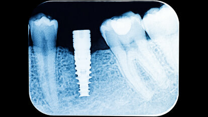 Periodontitis and Implant Complications: Update on the Linkage