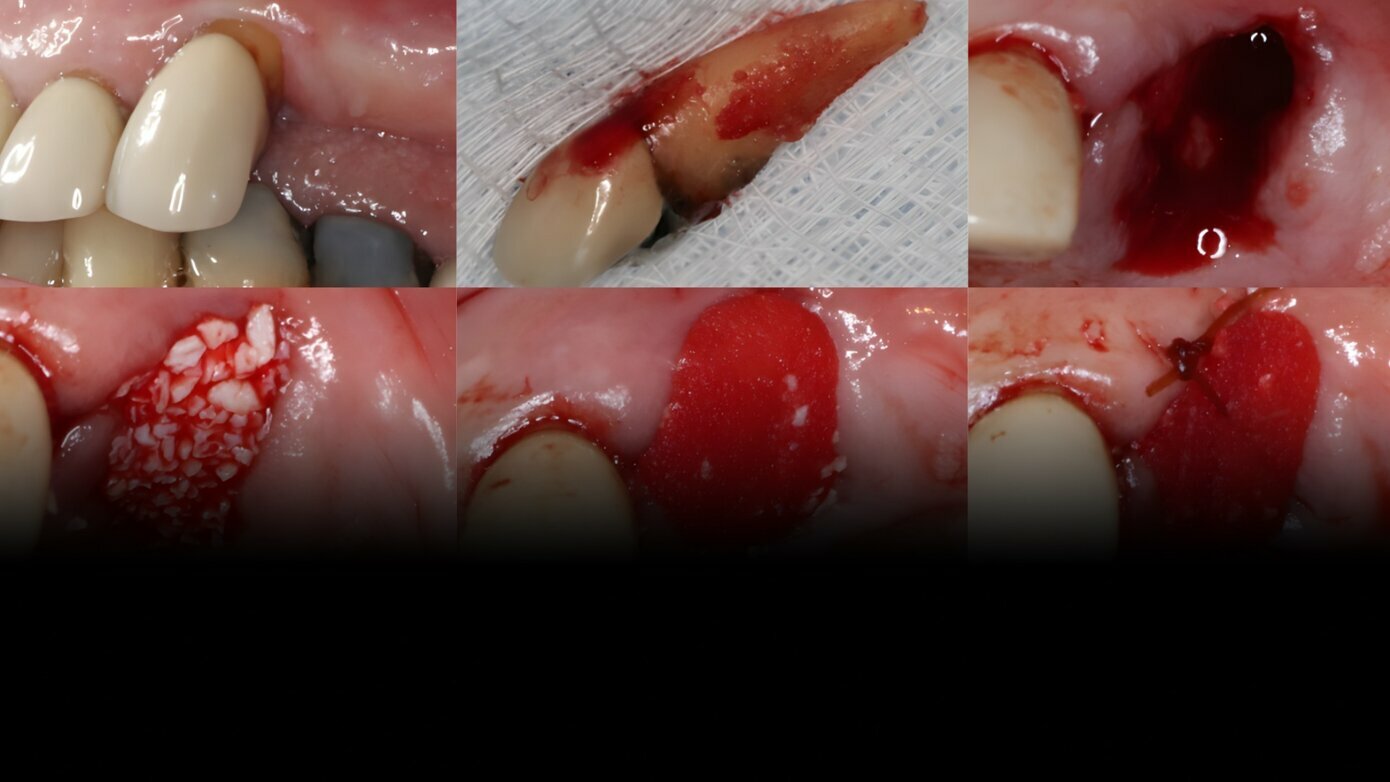 Post-extraction site management: The when, where and how to obtain the best possible clinical outcomes