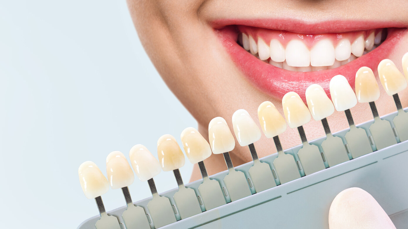 The Next Generation in Vital Tooth Whitening (Bleaching)