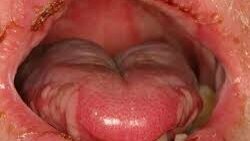 Oral Mucositis: Oral Impact, Sequelae and Management