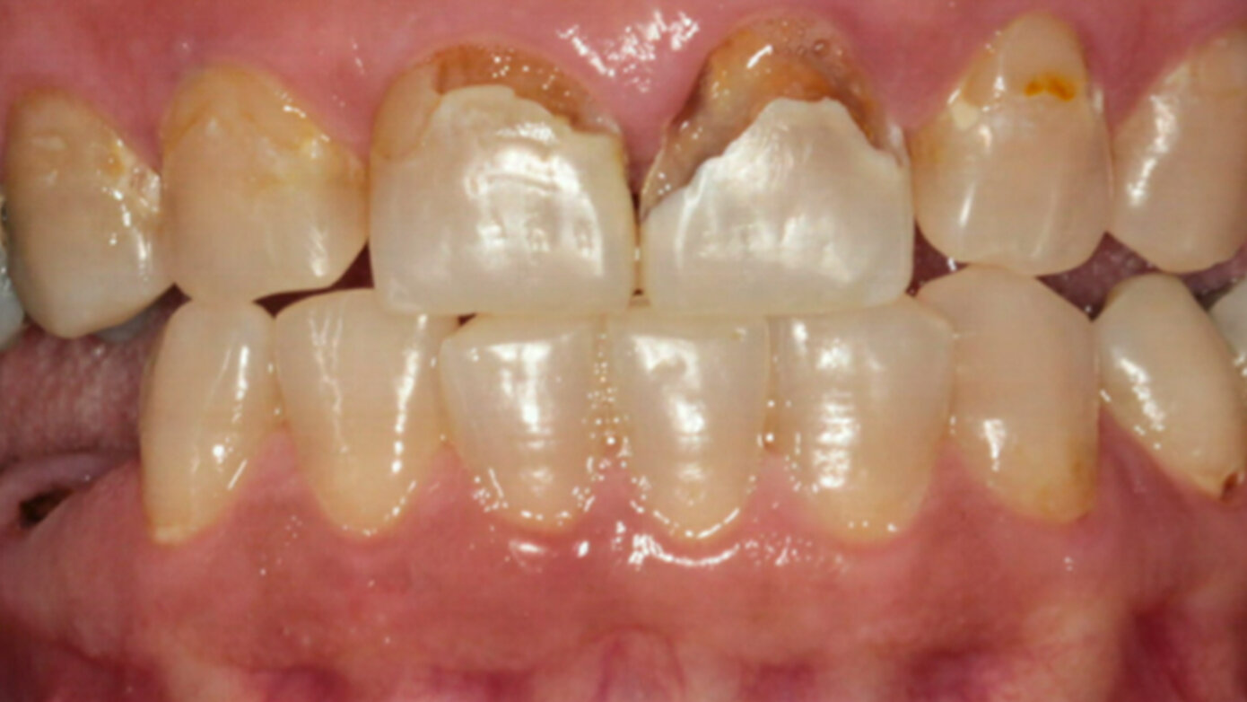 Multidisciplinary case study on an partially edentulous adult patient