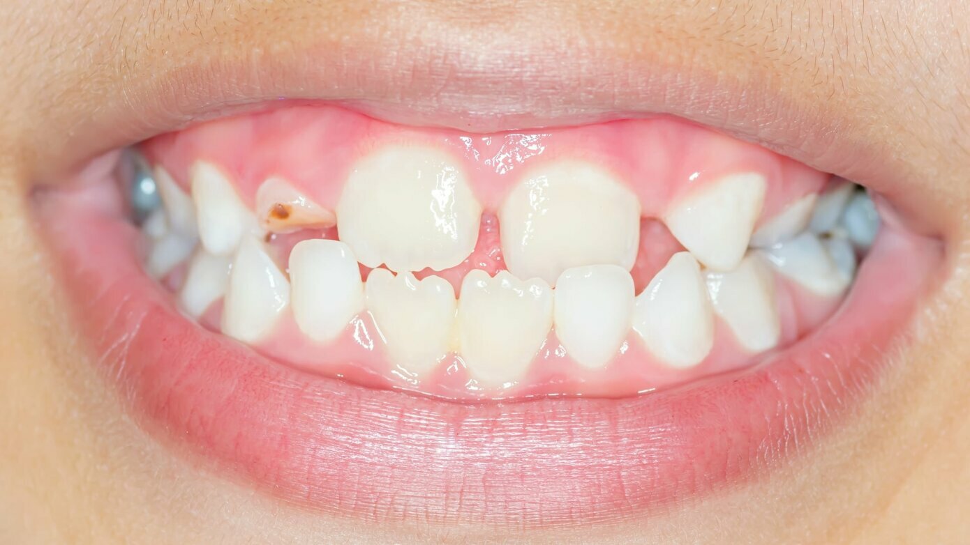 Paediatric Dentistry Evidence Uncovered: Global Consensus in Action