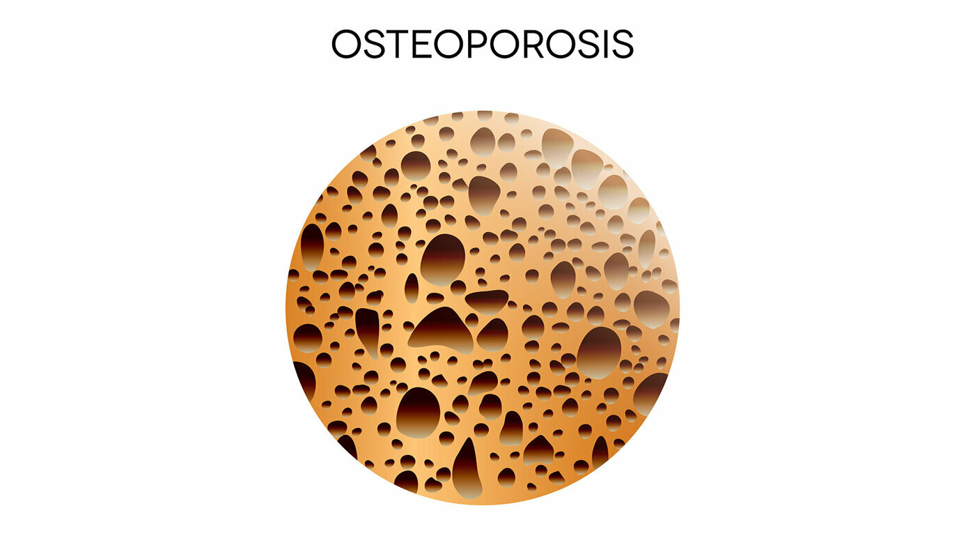 Osteoporosis and Dental Implant Outcomes