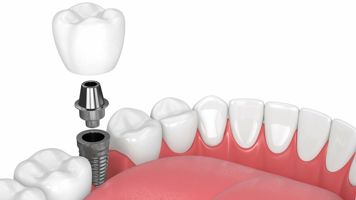 Implant Maintenance for Long Term Success