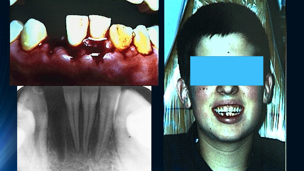Update on Dental Trauma