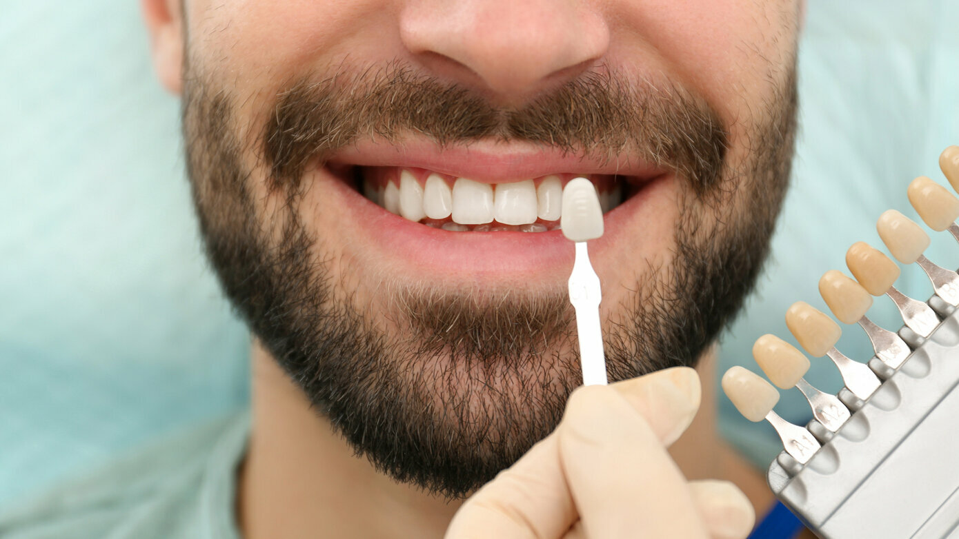 An Update on Tooth Whitening