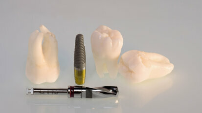 Tooth Retention vs. Tooth Extraction and Implant Placement