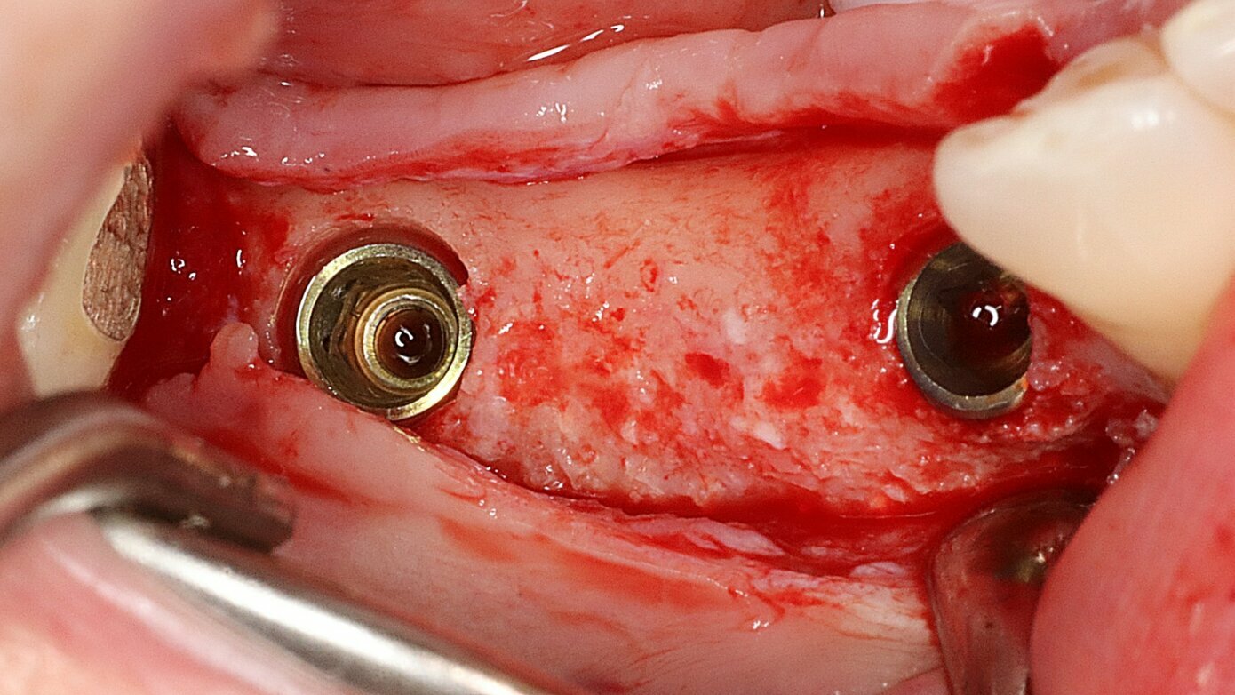 Optimized Dental Implant Osseointegration: Cellular Mechanisms, Timelines, and Patient Factors