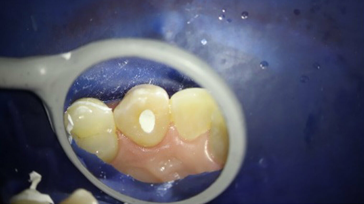 Endodontically Treated Teeth and the Walking Bleach Technique
