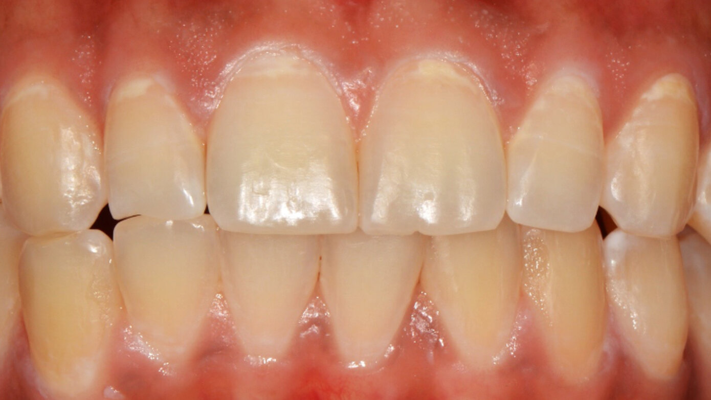 Caries Risk Assessment and Patient Management Strategies