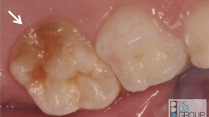 Reconsidering Molar Hypomineralization and “Chalky Teeth”