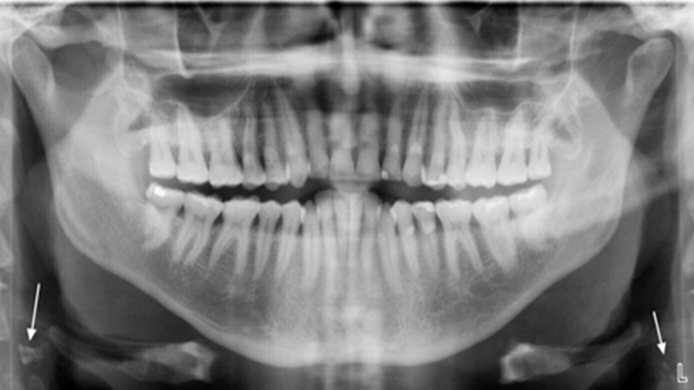 Identification of Carotid Artery Calcifications in Panoramic Dental Radiographs