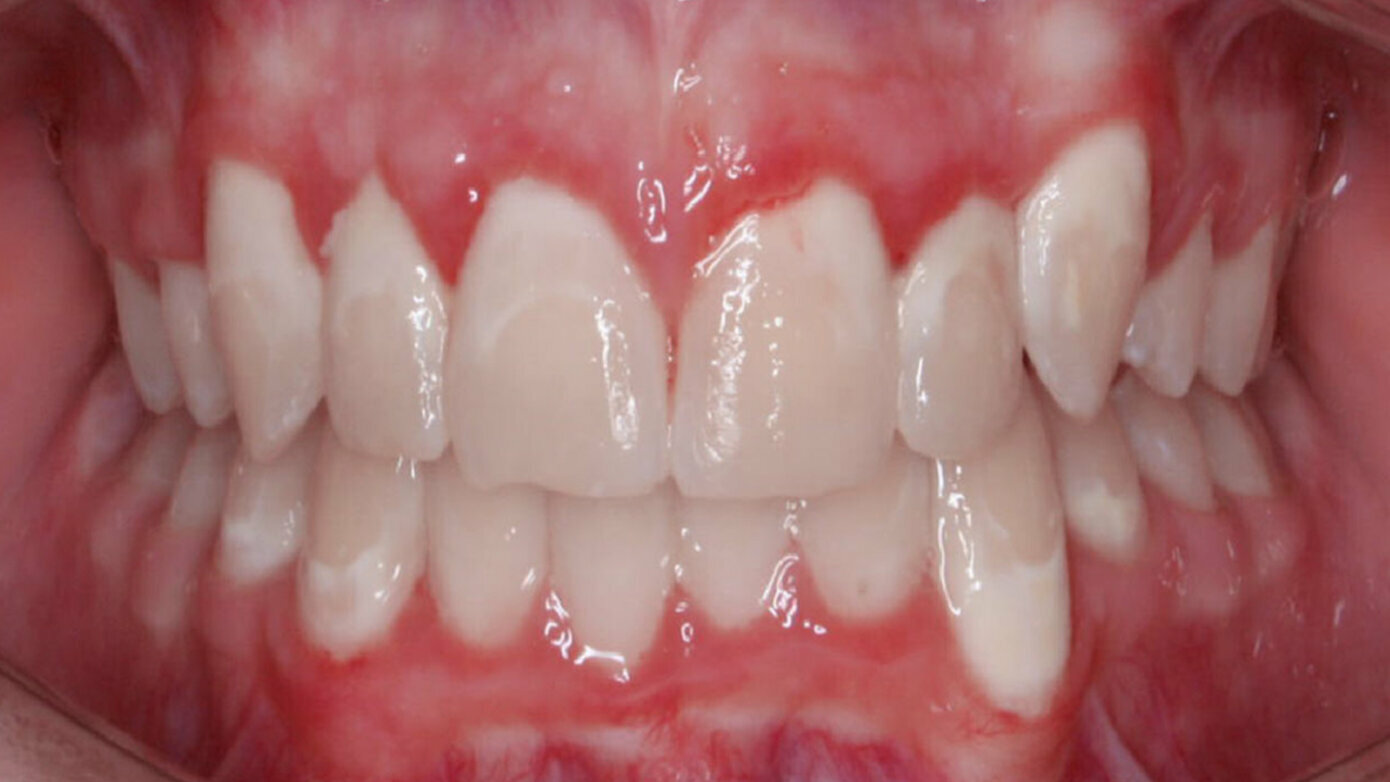 Orthodontic Treatment and White Spot Lesions