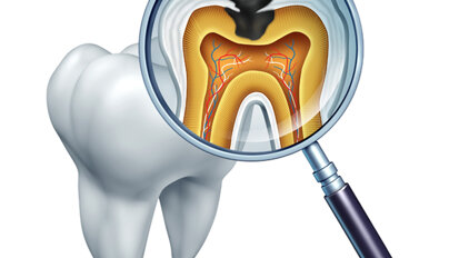New Clinical Guidelines for Caries Management