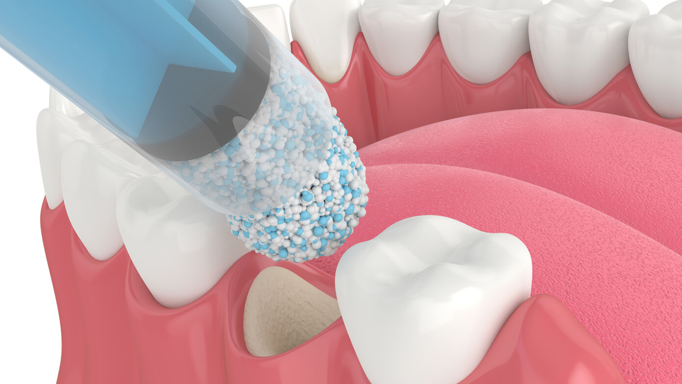 Periodontal Regeneration: Saving the Natural Dentition