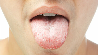 Trends and Demographics: Dry Mouth