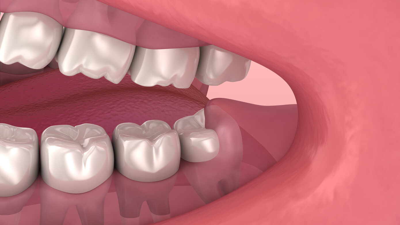 Management of Wisdom Teeth for the General Dentist