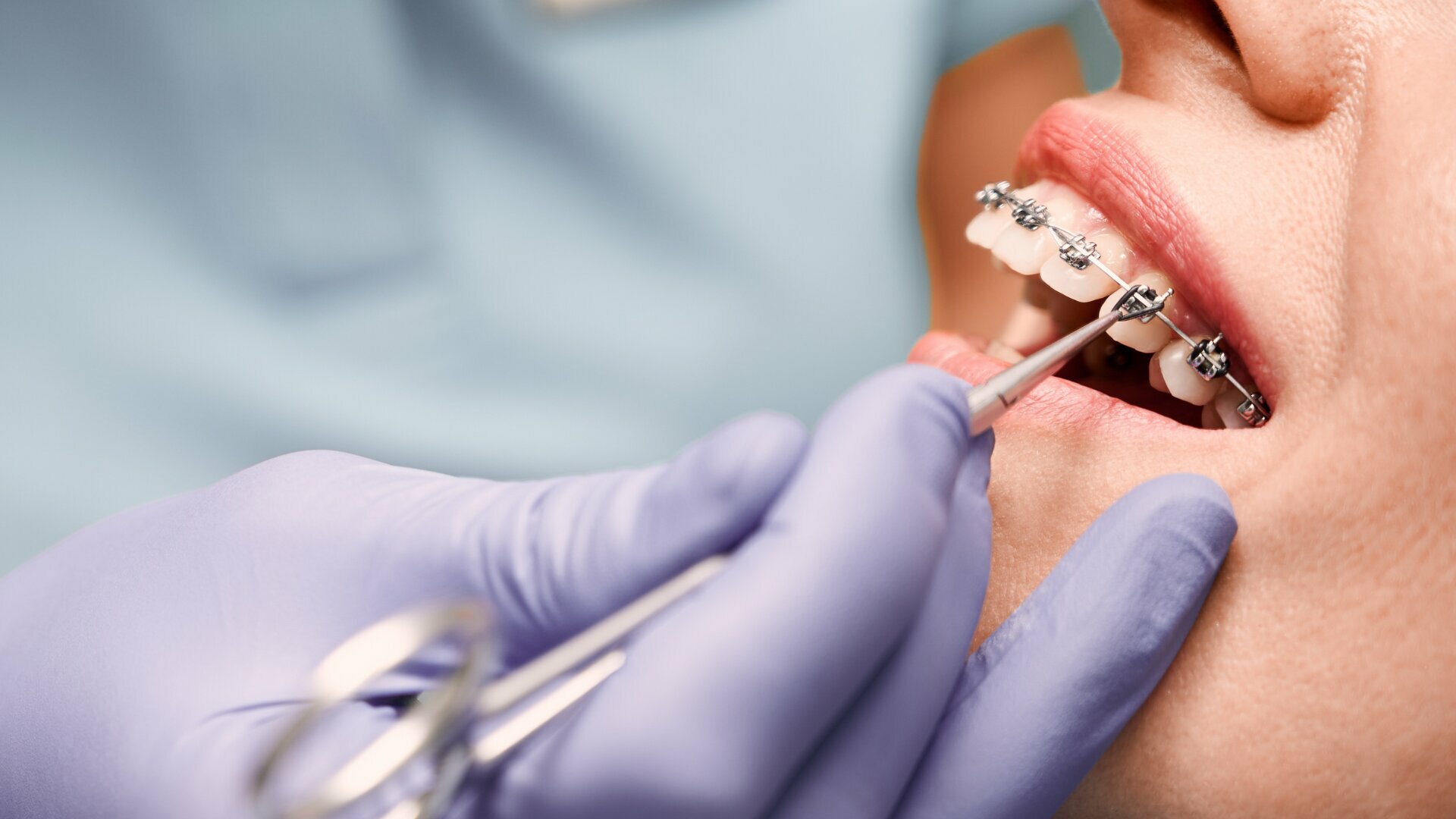 Zahnmedizinische Prävention während der kieferorthopädischen Behandlung