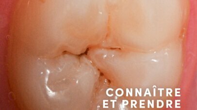 Connaître et prendre en charge les lésions carieuses 