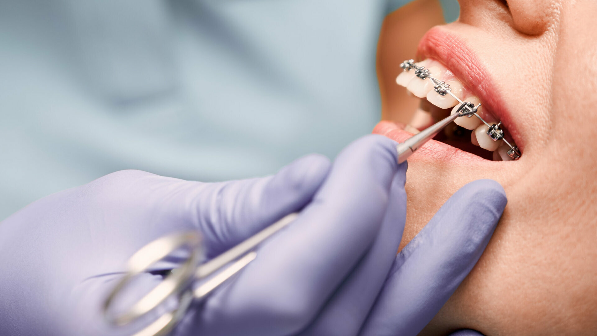 L'importanza della fluoroprofilassi nel paziente ortodontico