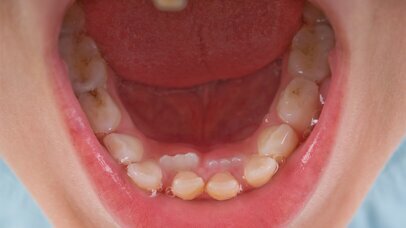 Diagnostyka wczesnych zmian próchnicowych