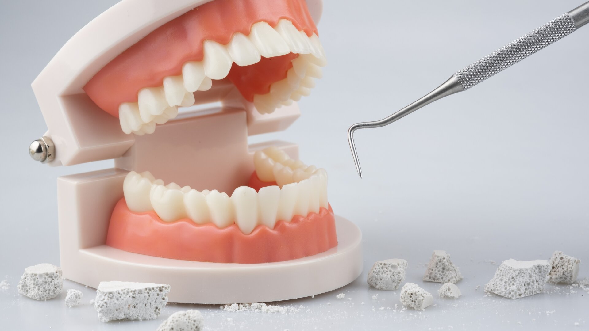 COLGATE X Olivia Kerouredan : évaluation des lésions (érosion dentaire)