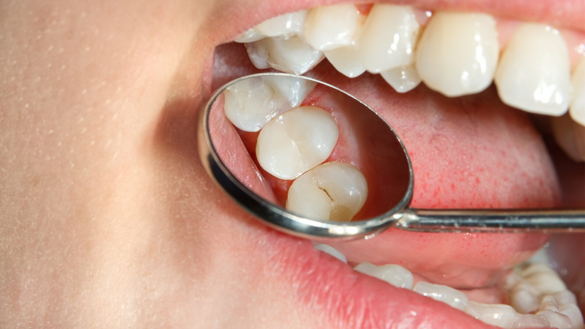 Hamburger Prophylaxe Update 2025