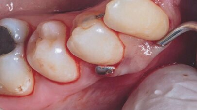 Regenerative PAR-Chirurgie und aktuelle Standards in der Parodontitis-Therapie
