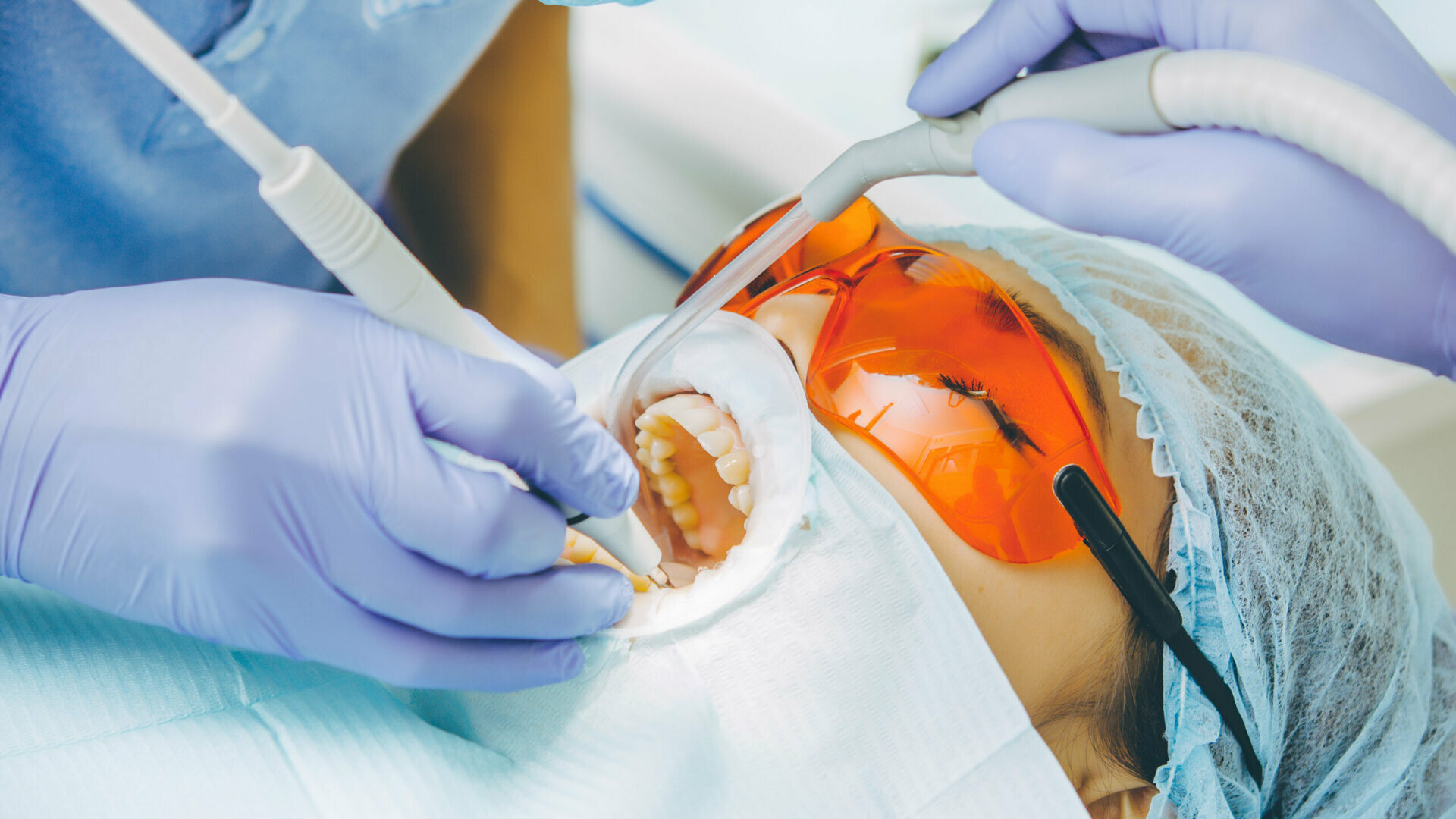 Fluoro e remineralizzazione: concetti attuali in odontoiatria preventiva