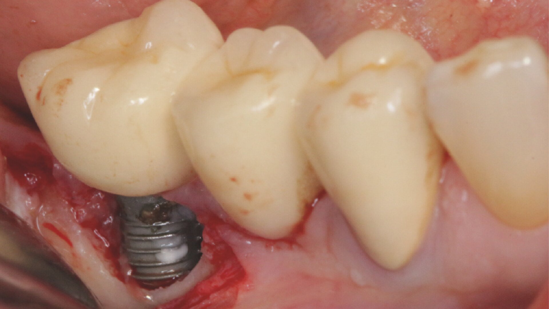 Prophylaxe in der Implantologie