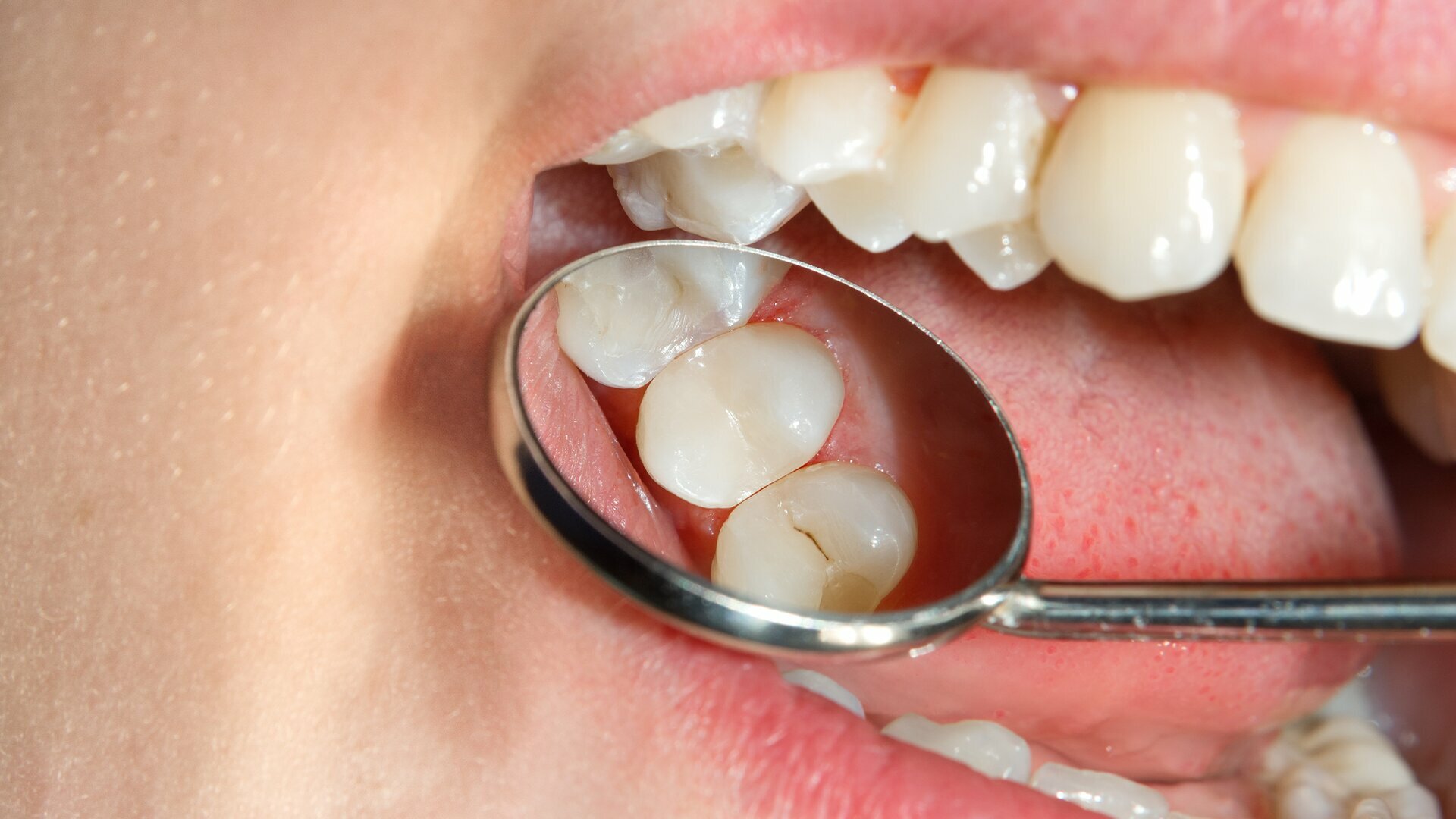 Próchnica: etiologia, przebieg oraz diagnostyka