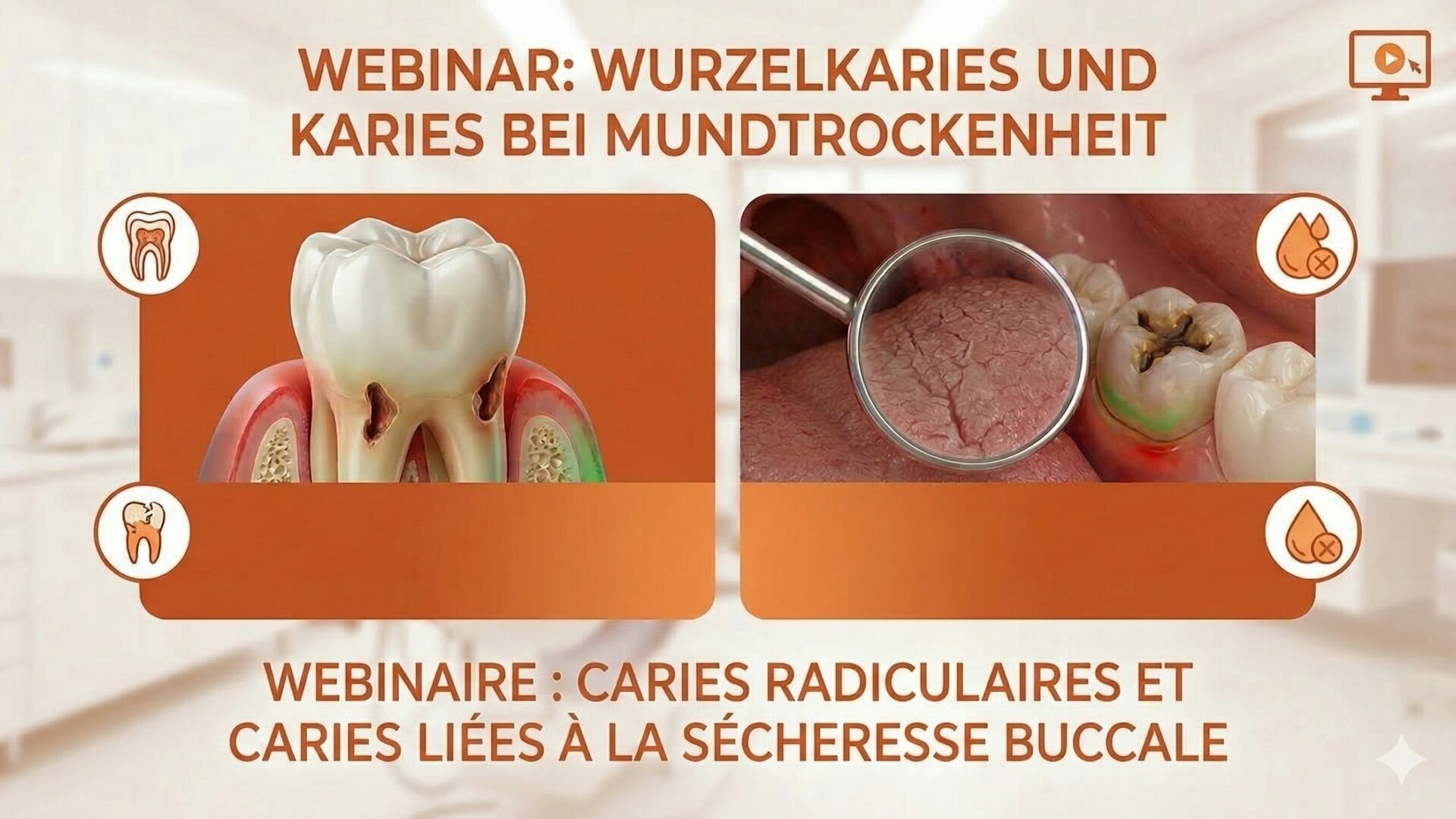 Wurzelkaries und Karies bei Mundtrockenheit