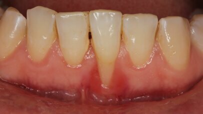 Host Modulation For The Treatment Of Periodontal Diseases