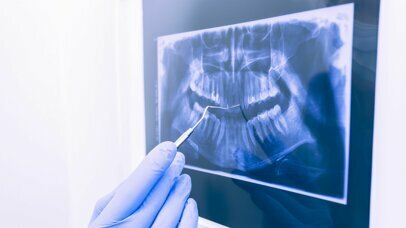 Relative anti-caries efficacy of 1100, 1700, 2200, and 2800 ppm fluoride ion in a sodium fluoride dentifrice over 1 year