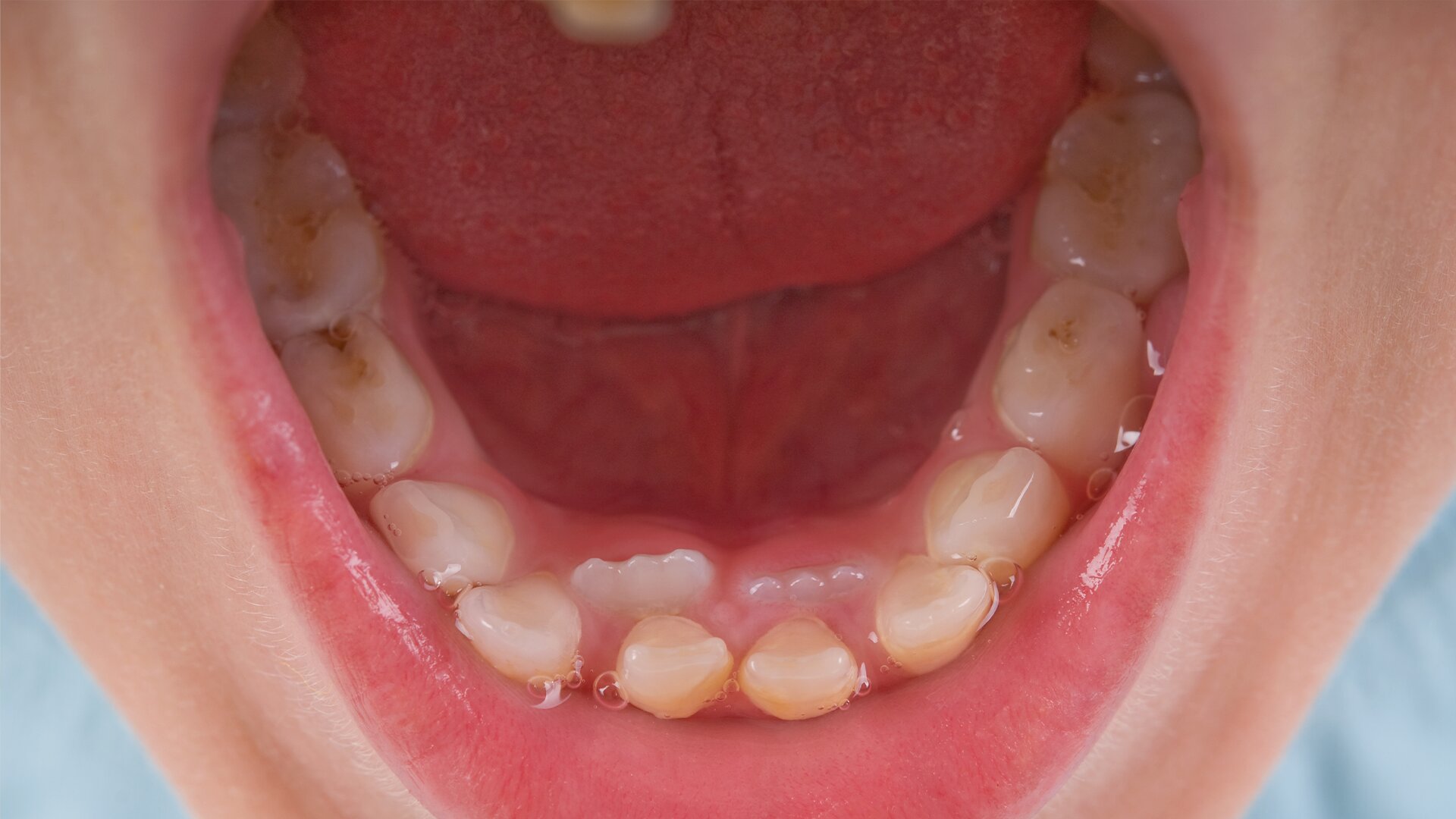 Diagnostyka wczesnych zmian próchnicowych