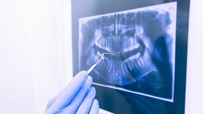 Systematic Review Shows That Duraphat® 5000 ppm Fluoride Toothpaste Provides 51% More Inactivation of Root Caries