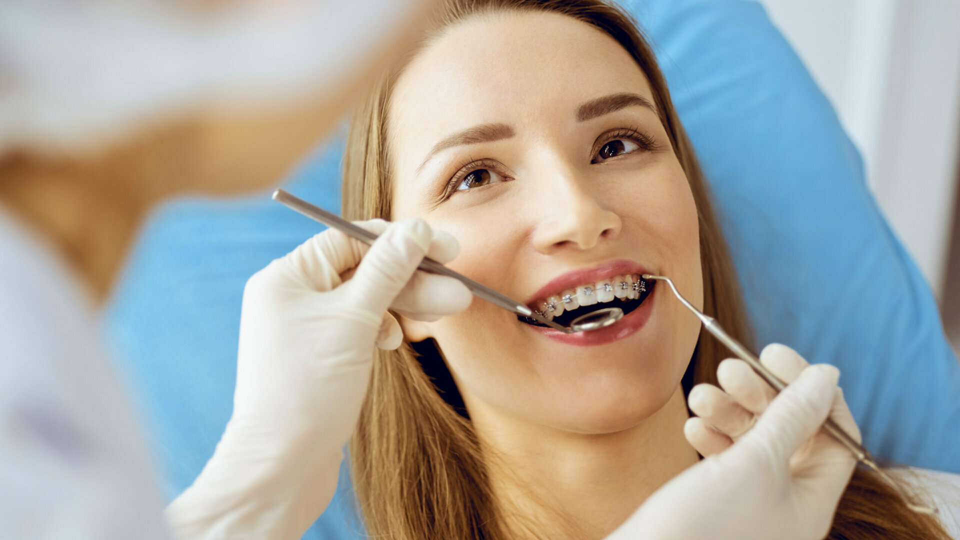 Fluoro e ortodonzia: prevenzione e gestione della carie