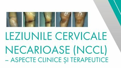 Broșura Leziuni Cervicale Necarioase, Autor: Dr. Andreea Stănuși