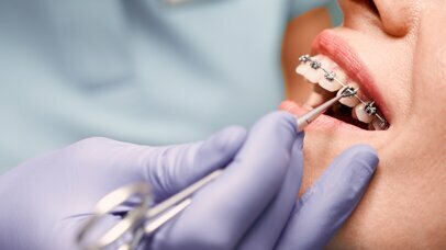 Zahnmedizinische Prävention während der kieferorthopädischen Behandlung